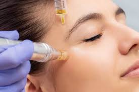 PRP Microneedling