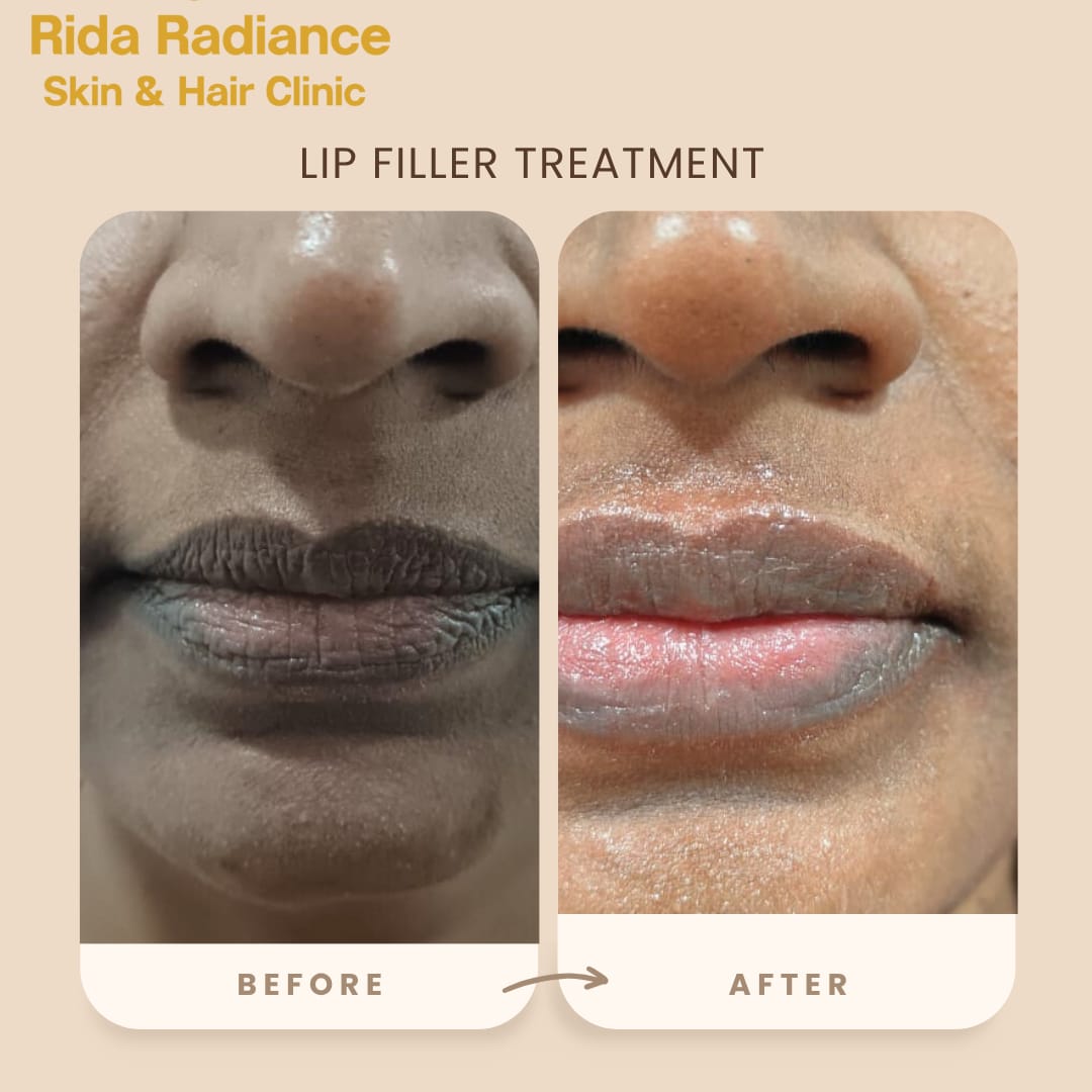 Lip filler treatment in Gachibowli