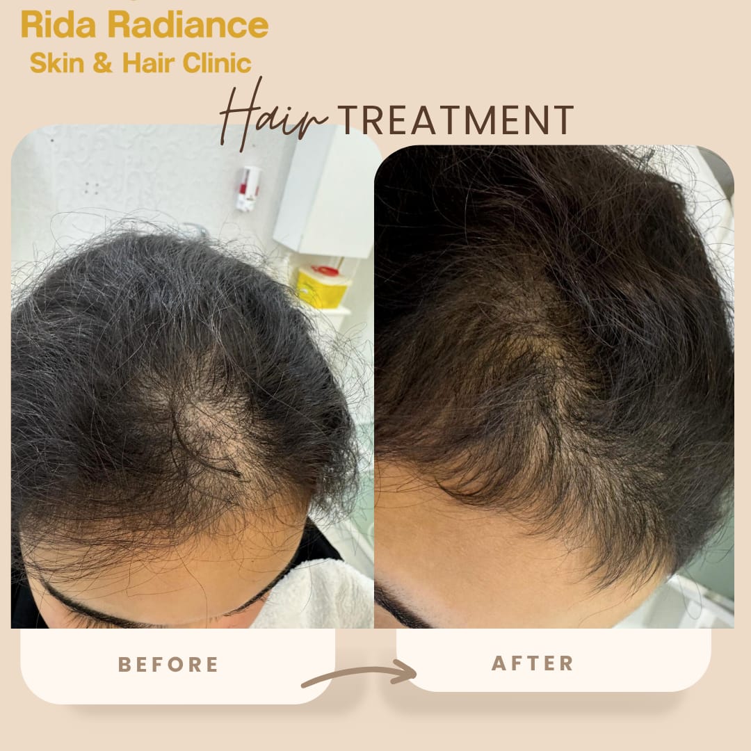 Hair density treatment in Gachibowli
