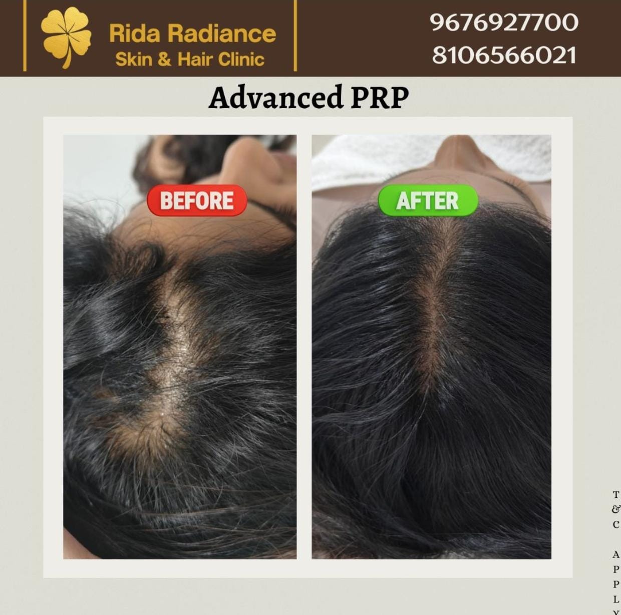 Hairline Restoration in Gachibowli