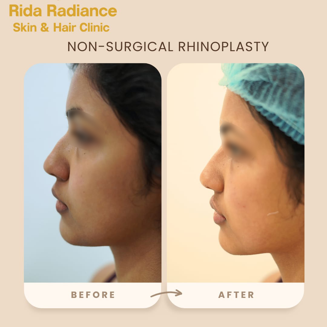 Non-surgical rhinoplasty before and after