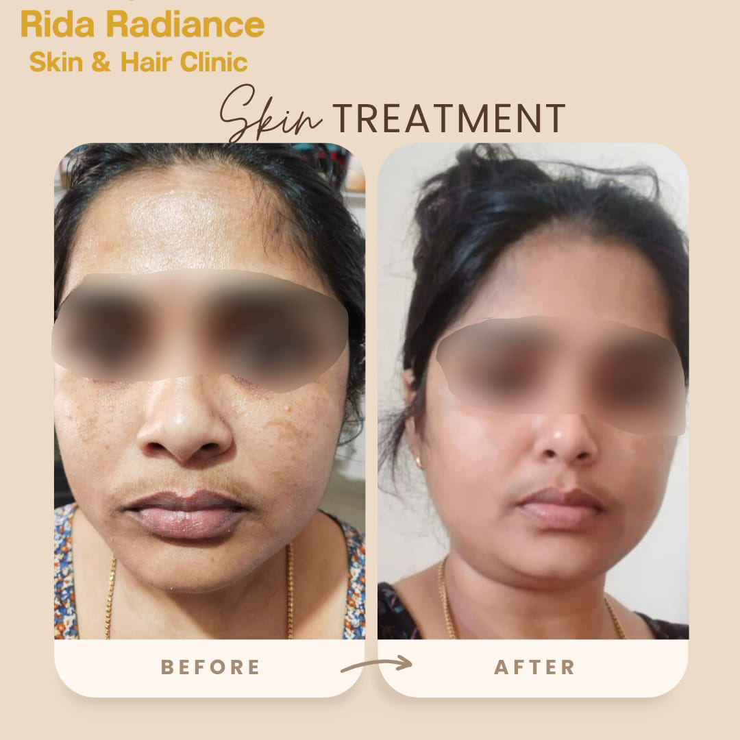 Dermal fillers before and after