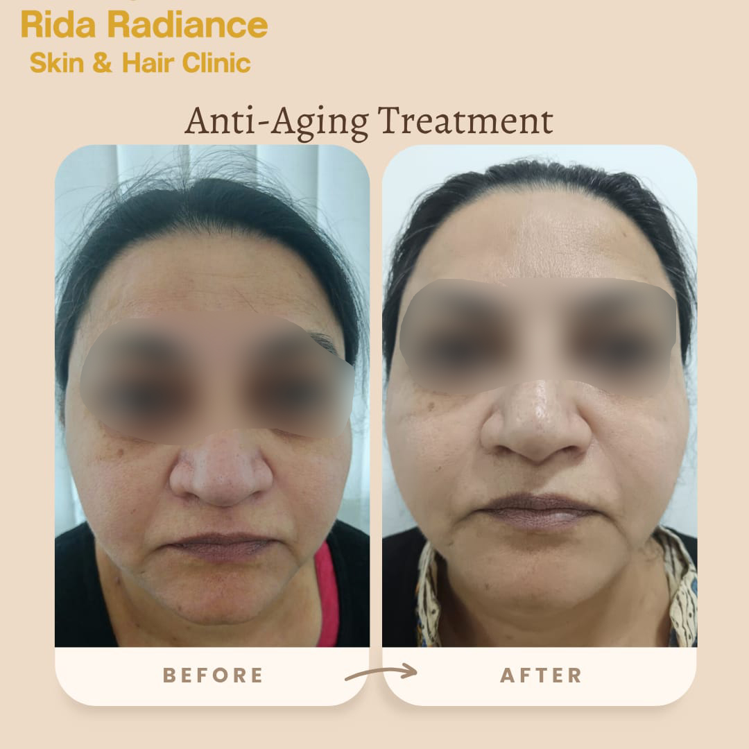Botox before and after