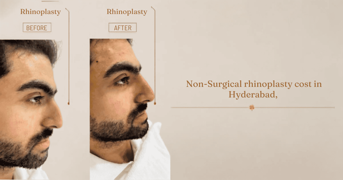 Non-surgical rhinoplasty before and after profile view at Rida Radiance clinic in Hyderabad