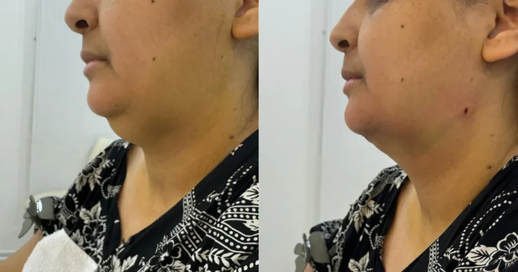 Double chin reduction before and after at Rida Radiance Skin & Hair Clinic, Hyderabad